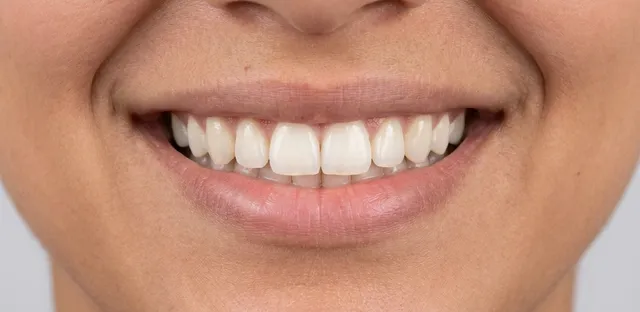 Smile after orthodontic treatment at Ora
