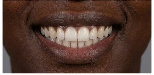 Smile after orthodontic treatment at Ora