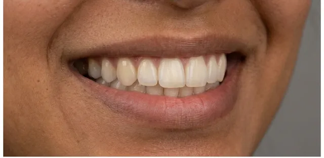 Smile after orthodontic treatment at Ora