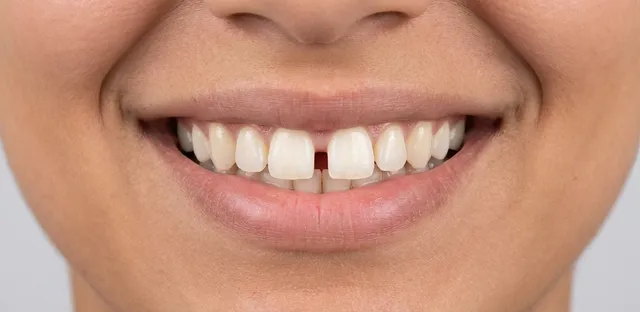 Smile before orthodontic treatment at Ora