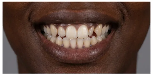 Smile before orthodontic treatment at Ora