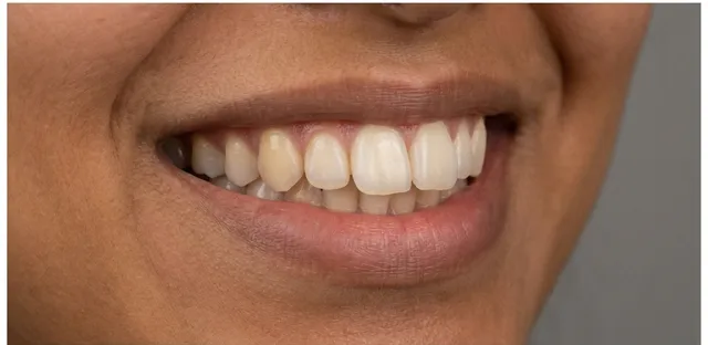 Smile before orthodontic treatment at Ora