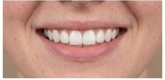 Smile after Invisalign treatment at Ora