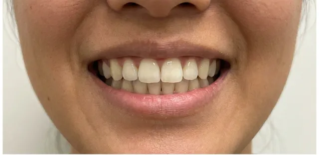 Smile after Invisalign treatment
