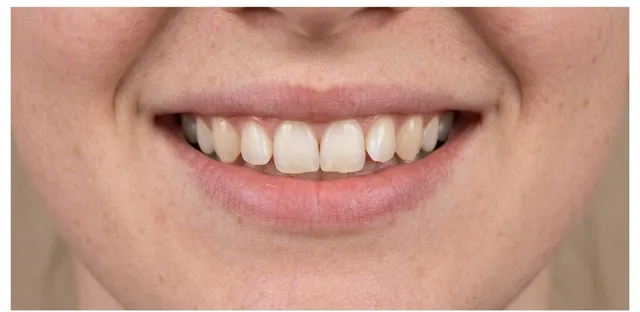 Smile before Invisalign treatment