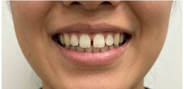 Smile before Invisalign treatment