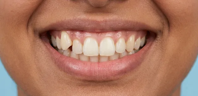Smile before Invisalign treatment