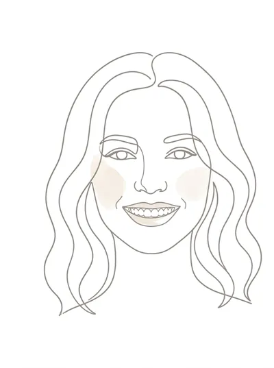 Illustration of facial musculature supported by veneers