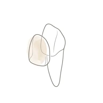 Even, natural-looking teeth after veneers