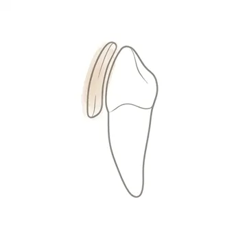 Worn down teeth before veneers